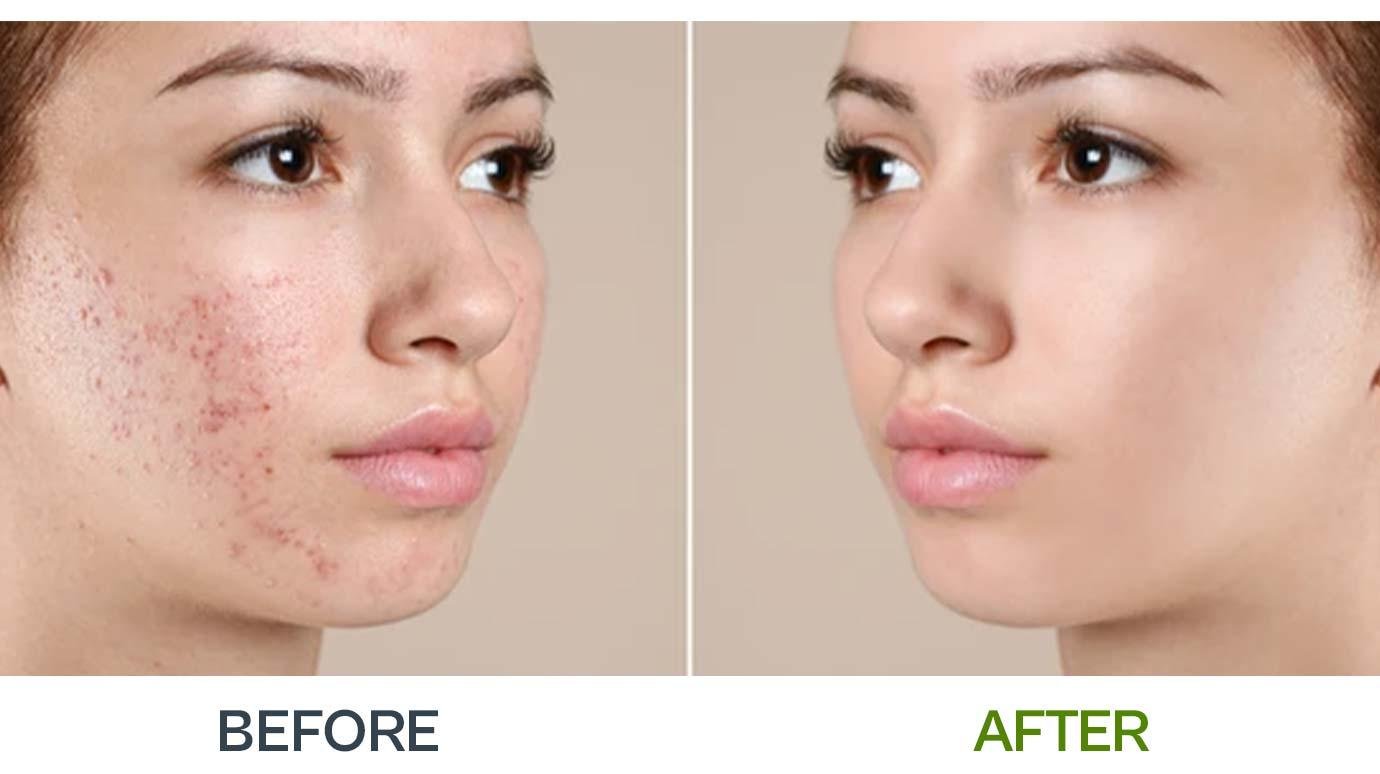 Acne Treatment
