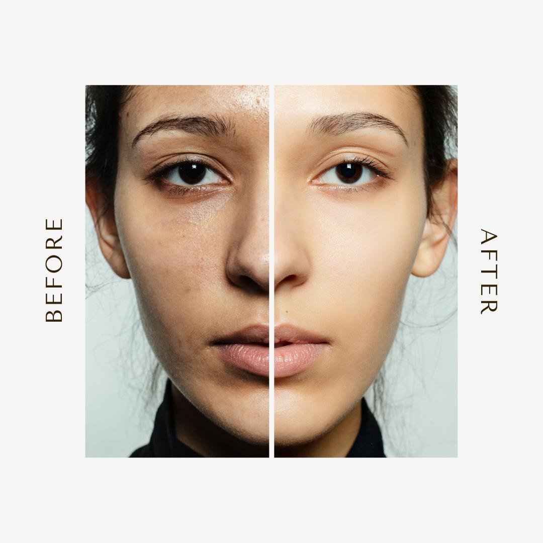 Skin Brightening